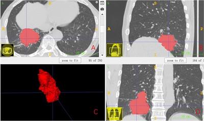 CT-based radiomics in predicting pathological response in non-small cell lung cancer patients receiving neoadjuvant immunotherapy